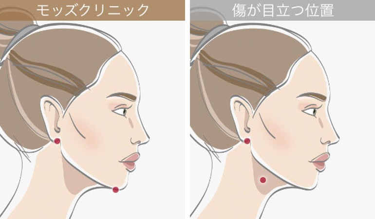 傷跡の位置の説明画像