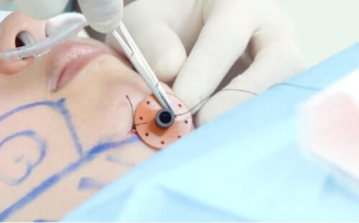 スキンポートの画像