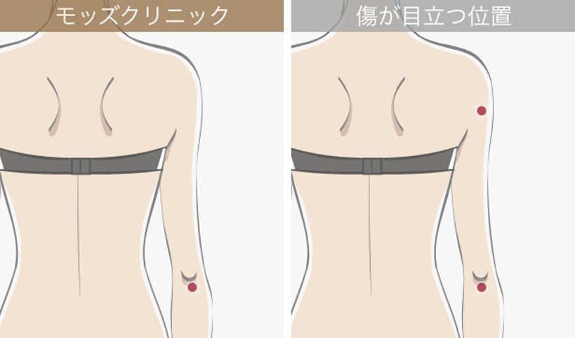 挿入口を最小限にする説明画像